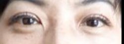 Asian Crease & Double Eyelid Surgery case #10550