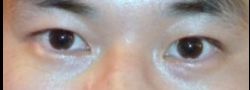 Asian Crease & Double Eyelid Surgery case #10556