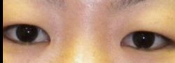 Asian Crease & Double Eyelid Surgery case #10563