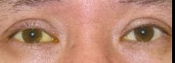 Asian Crease & Double Eyelid Surgery case #10566