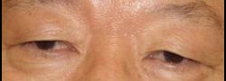 Asian Crease & Double Eyelid Surgery case #10569