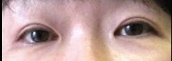 Asian Crease & Double Eyelid Surgery case #10578