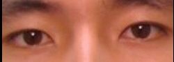 Asian Crease & Double Eyelid Surgery case #10581