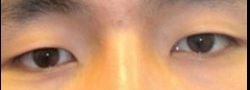 Asian Crease & Double Eyelid Surgery case #10581