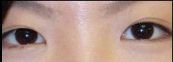 Asian Crease & Double Eyelid Surgery case #10594