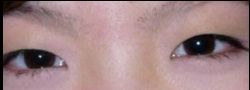 Asian Crease & Double Eyelid Surgery case #10594