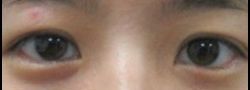 Asian Crease & Double Eyelid Surgery case #10541