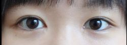 Asian Crease & Double Eyelid Surgery case #10616