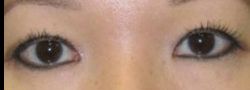 Asian Crease & Double Eyelid Surgery case #10619