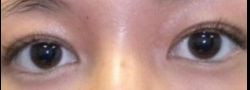 Asian Crease & Double Eyelid Surgery case #10625