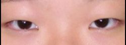 Asian Crease & Double Eyelid Surgery case #10628