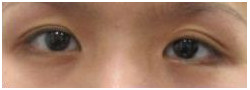Asian Crease & Double Eyelid Surgery case #10634