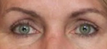 Brow Lift case #10924