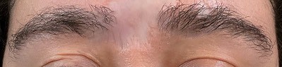 Hair Restoration case #11856