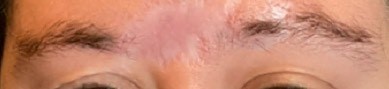 Hair Restoration case #11856