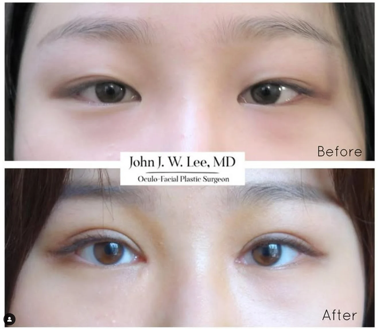 asian eyelid