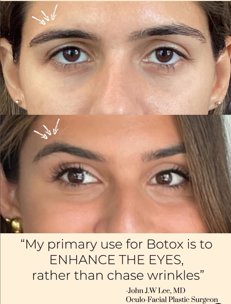 botoxbxa