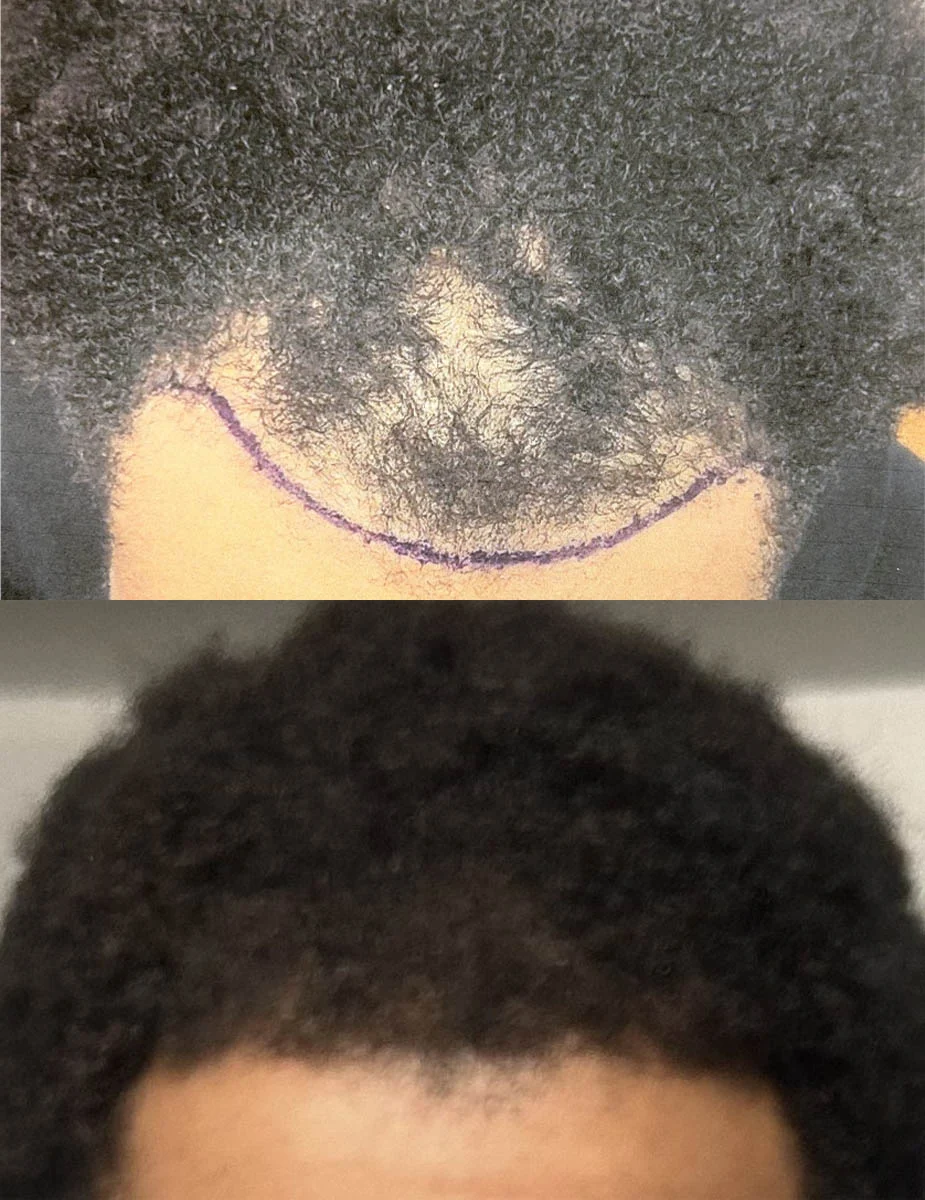 hairrestorationintro (2)